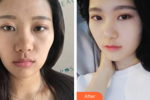 泉州西華醫(yī)療美容醫(yī)院廉樂天整形價(jià)格表附抗衰老—緊致祛皺—熱瑪吉案例展示