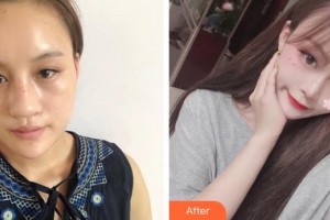 沈陽金皇后整形美容醫(yī)院朱久平整形價(jià)格表附眼部整形眼部綜合案例展示