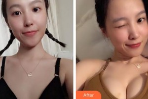 廣州曙光醫(yī)學(xué)美容醫(yī)院張元龍整形價格表附濃縮豐胸案例展示