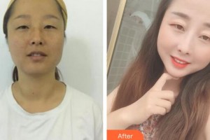 廣州華美醫(yī)療美容醫(yī)院丁彥整形價格表附白瓷案例展示