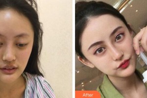 廣州粵秀整形外科醫(yī)院徐士亮整形價格表附鼻部手術(shù)案例展示