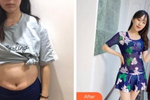 廣州遠(yuǎn)東美容醫(yī)院袁欣整形價格表附美體塑形案例展示