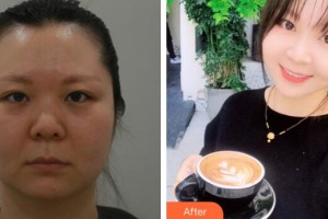 廣州博仕整形美容醫(yī)院朱平整形價格表附多方面部埋線提升案例展示