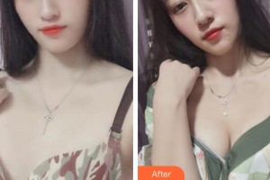 廣州美萊醫(yī)療美容醫(yī)院熊明根整形價格表附濃縮豐胸案例展示