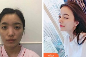 廣州曙光醫(yī)學(xué)美容醫(yī)院蔣思軍整形價格表附鼻部手術(shù)案例展示