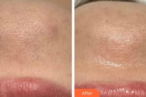 廣州美恩整形美容醫(yī)院黃禮整形價格表附皮膚深層清潔案例展示