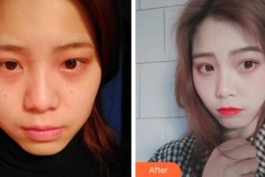 上海德琳醫(yī)療美容醫(yī)院付瑾整形價(jià)格表附光子嫩膚案例展示