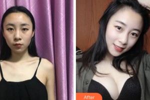 成都漢密爾頓美容醫(yī)院洪偉整形價(jià)格表附假體隆胸案例展示