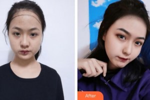 上海天大醫(yī)療美容醫(yī)院金修均整形價(jià)格表附美女發(fā)際線種植案例展示