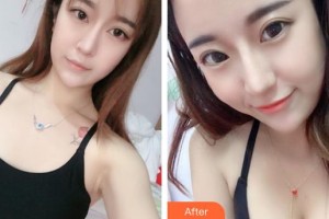 上海天大醫(yī)療美容醫(yī)院朱健康整形價(jià)格表附濃縮脂肪豐胸案例展示