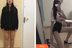 上海紐菲思醫(yī)療美容門診部朱維玲整形價(jià)格表附大腿吸脂案例展示
