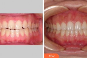 上海一美整形外科醫(yī)院　張社濱整形價(jià)格表附牙齒正畸案例展示