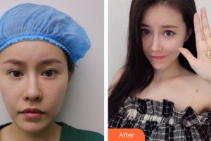 上海一美整形外科醫(yī)院　岳偉整形價(jià)格表附	膨體豐眉弓案例展示