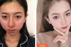 廣州新時代整形美容醫(yī)院饒曉艷美容皮膚醫(yī)師 咨詢培訓師整形價格表附健康素顏肌案例展示