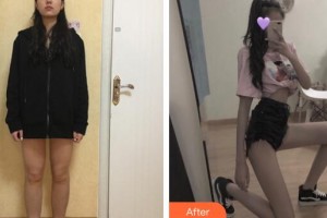 廣州新時代整形美容醫(yī)院張世東整形價格表附大腿吸脂案例展示