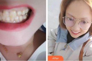 上海一美整形外科醫(yī)院　鮮運(yùn)科整形價(jià)格表附烤瓷牙牙齒貼面案例展示