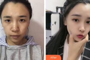 上海東方麗人美容醫(yī)療醫(yī)院李哲整形價(jià)格表附安琪拉芭比眼案例展示