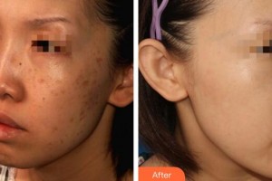 廣州美萊醫(yī)療美容醫(yī)院潘萍整形價格表附曬斑調節(jié)案例展示
