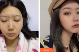 上海仁愛醫(yī)院整形美容科楊洪波整形價(jià)格表附顴骨顴弓降低案例展示