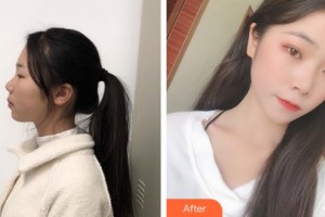 上海東方麗人美容醫(yī)療醫(yī)院谷曉輝整形價(jià)格表附超激光美膚祛斑美膚案例展示