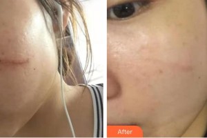 上海仁愛醫(yī)院整形美容科彭才學(xué)整形價(jià)格表附點(diǎn)陣祛疤痕案例展示