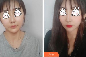 上海麗人整形美容醫(yī)院崔潔整形價格表附無針?biāo)獍咐故?>
</a>
<h3 class=