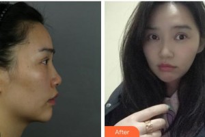 上海宏康醫(yī)院整形美容中心姜元植主診醫(yī)師整形價格表附	顴骨+頰脂墊+下頜角+皮質(zhì)骨案例展示