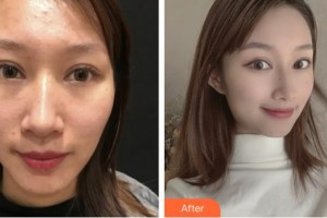 上?？祳W醫(yī)療美容醫(yī)院趙華整形價格表附微針祛痘案例展示