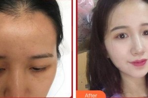 上?？祳W醫(yī)療美容醫(yī)院白俊杰整形價格表附發(fā)際線種植案例展示