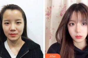 上海康奧醫(yī)療美容醫(yī)院錢麟整形價格表附美鼻部手術(shù)案例展示