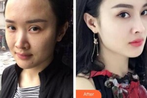 鄂爾多斯百達麗整形美容醫(yī)院李英春整形價格表附熱瑪吉頸部體驗案例展示