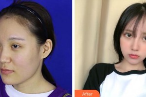 珠海華澳醫(yī)療美容整形門診部鄧強整形價格表附鼻部手術案例展示