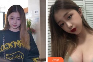 中山百佳婦產醫(yī)院醫(yī)療美容科李韻芳整形價格表附假體隆胸案例展示