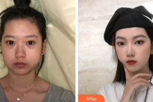 廣州華美醫(yī)療美容醫(yī)院李春滿整形價格表附下頜角磨骨案例展示