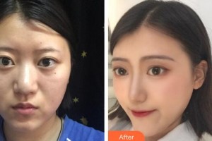 廣州名韓醫(yī)療美容醫(yī)院孫曉捷整形價格表附肋軟骨鼻部手術案例展示