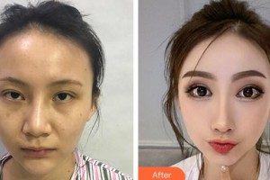 廣州軍區(qū)總醫(yī)院全軍激光整形美容中心彭麗霞整形價格表附鼻部手術整形案例展示