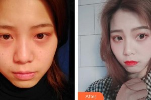 廣州時光整形美容醫(yī)院阿曼博士整形價格表附激光美膚激光案例展示