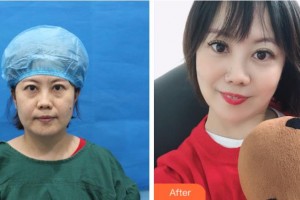 三門峽常亮醫(yī)療美容診所常亮整形價(jià)格表附不開(kāi)刀祛眼袋+自體脂肪填充淚案例展示