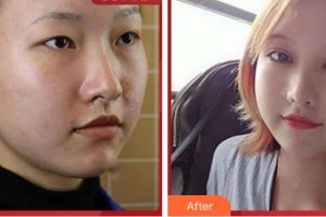 上海玫瑰醫(yī)療美容醫(yī)院金振口整形價格表附Park法復(fù)式切開雙眼皮案例展示