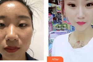 武警上?？傟犪t(yī)院整形美容中心曹慧整形價格表附激光祛斑美白肌膚案例展示