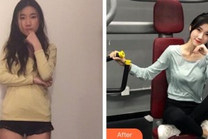 廣州愛來（原阿瑪施）醫(yī)療美容整形醫(yī)院余花整形價格表附玻尿酸導入案例展示