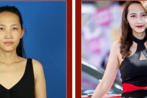 武警上?？傟犪t(yī)院整形美容中心王慕 整形價格表附自體脂肪隆胸案例展示