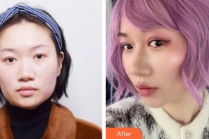 廣州美萊醫(yī)療美容醫(yī)院金憲俊整形價格表附埋線雙眼皮+去脂案例展示