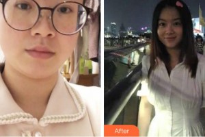 上海時光整形外科醫(yī)院于晶天整形價格表附溶脂案例展示