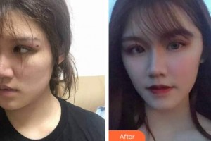 廣州時光整形美容醫(yī)院穆鈺整形價格表附人魚膠提升術案例展示