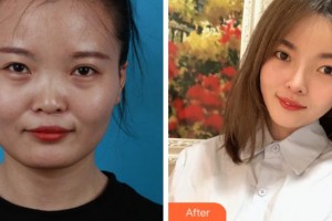 上海美之源整形外科醫(yī)院趙敏整形價格表附臉型（顴骨+下頜角）+鼻部手術(shù)案例展示