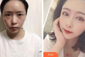 廣州軍區(qū)總醫(yī)院全軍激光整形美容中心孫瑞霞整形價格表附新月桃花眼部手術案例展示