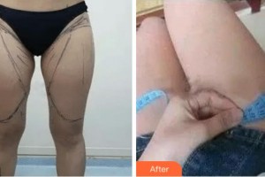 上海愛慕整形外科門診部何永強整形價格表附吸脂減大腿案例展示