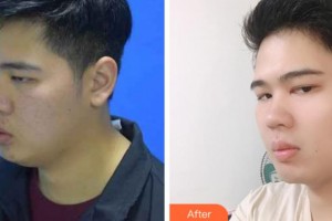 上海美立方整形醫(yī)院金秀哲整形價格表附縮脂針案例展示