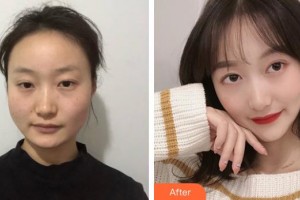 上海藝星醫(yī)療美容醫(yī)院崔海天整形價格表附下頜角磨骨案例展示